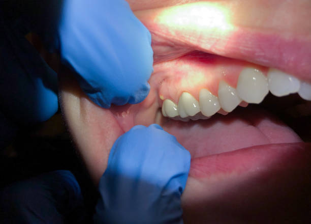Best Emergency Broken Tooth Repair in Warrensburg, IL